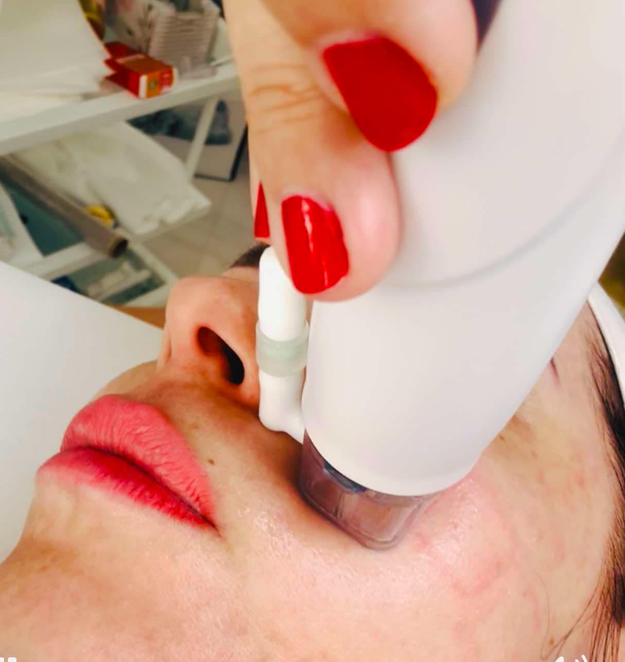 Mikrotűs rádiófrekvenciás kezelés az Apollon Beauty kozmetikai szalonban